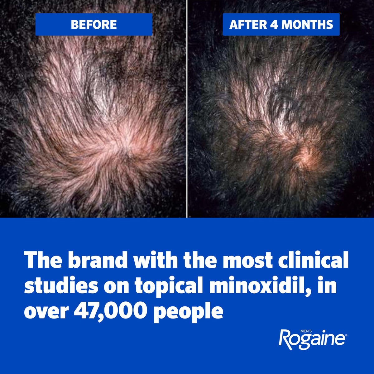 Rogaine 4